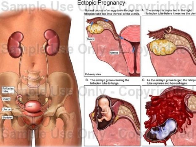 Small Breast Large Nipples Pregnant After Ectopic Pregnancy